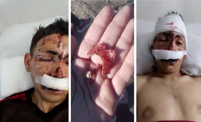 Merlo: dos hermanos golpearon a un joven hasta desfigurarlo y su hijo de siete años fue testigo del ataque