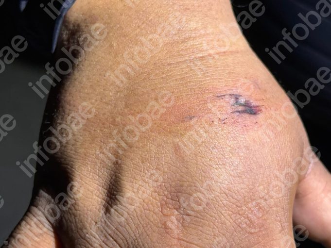 Triple femicidio narco: la foto de la supuesta mordedura en la mano del detenido en Villazón