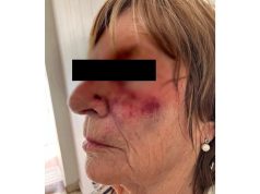 Brutal robo en Mar del Plata: destrozaron la dentadura de una jubilada de un golpe y atropellaron a su hija