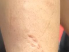 Una luchadora mostró cómo le quedó el brazo tras sufrir múltiples mordeduras de su rival durante el combate: “Dejaré que las marcas hablen”